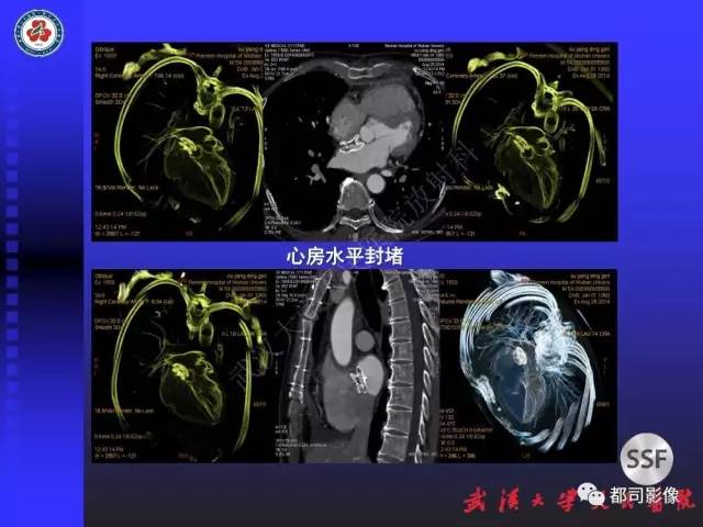 【PPT】CTA在血管病变术后评价中的应用