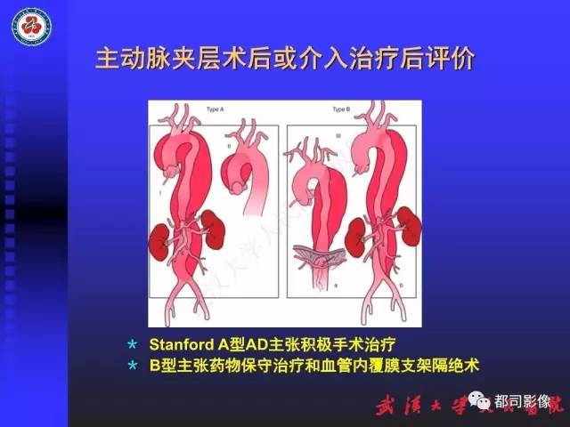 【PPT】CTA在血管病变术后评价中的应用
