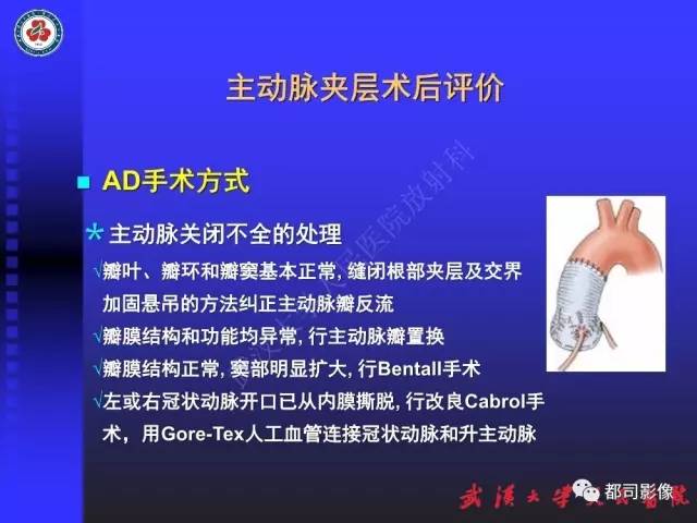 【PPT】CTA在血管病变术后评价中的应用