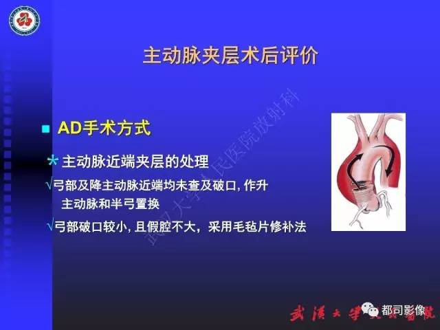 【PPT】CTA在血管病变术后评价中的应用