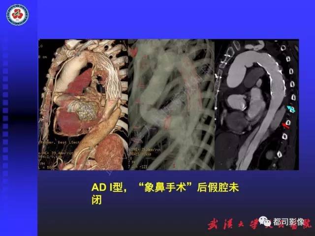 【PPT】CTA在血管病变术后评价中的应用