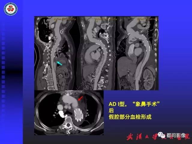 【PPT】CTA在血管病变术后评价中的应用