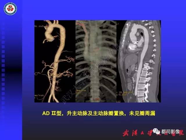 【PPT】CTA在血管病变术后评价中的应用