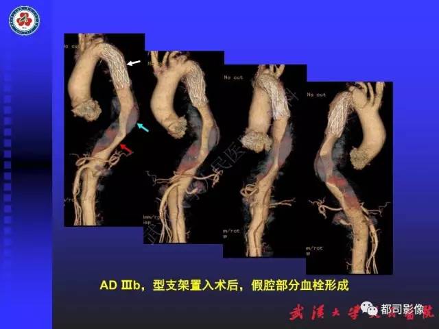 【PPT】CTA在血管病变术后评价中的应用