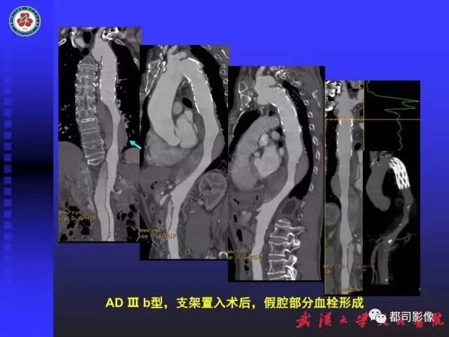 【PPT】CTA在血管病变术后评价中的应用