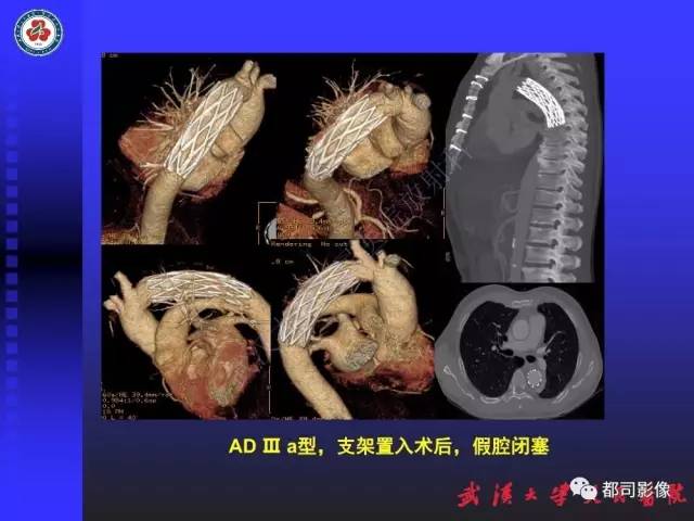 【PPT】CTA在血管病变术后评价中的应用