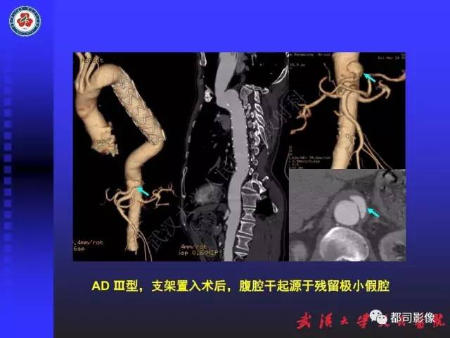 【PPT】CTA在血管病变术后评价中的应用