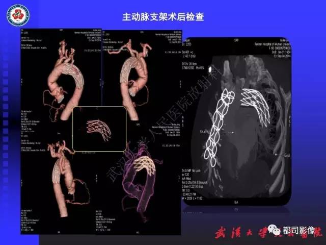 【PPT】CTA在血管病变术后评价中的应用