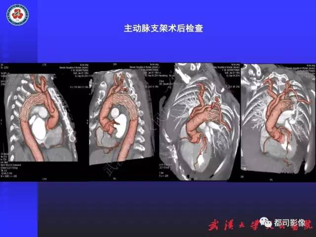 【PPT】CTA在血管病变术后评价中的应用