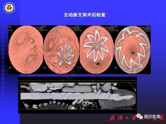 【PPT】CTA在血管病变术后评价中的应用