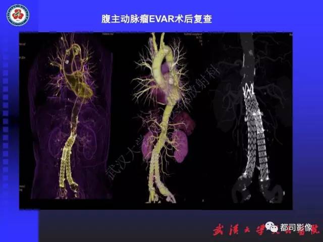 【PPT】CTA在血管病变术后评价中的应用