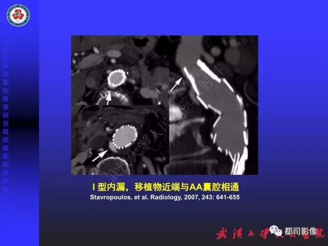 【PPT】CTA在血管病变术后评价中的应用