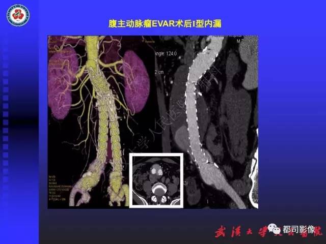【PPT】CTA在血管病变术后评价中的应用