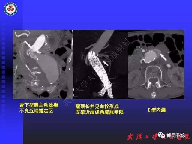 【PPT】CTA在血管病变术后评价中的应用