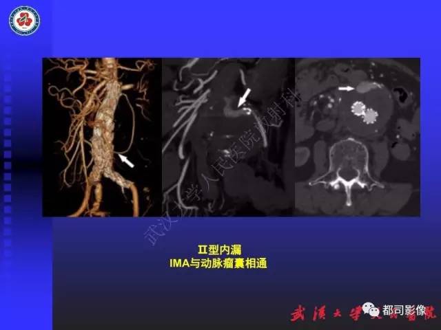 【PPT】CTA在血管病变术后评价中的应用