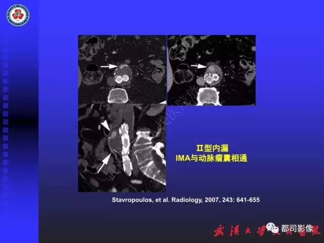 【PPT】CTA在血管病变术后评价中的应用
