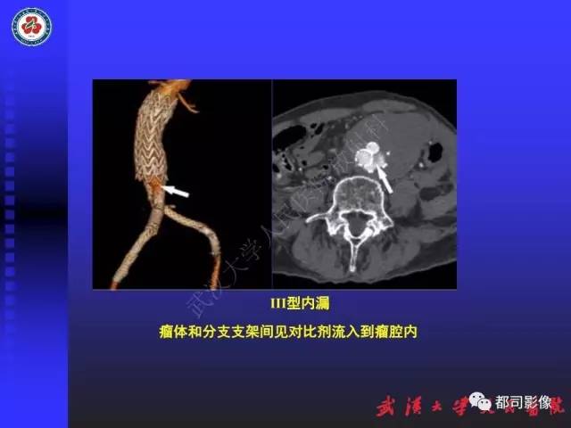 【PPT】CTA在血管病变术后评价中的应用