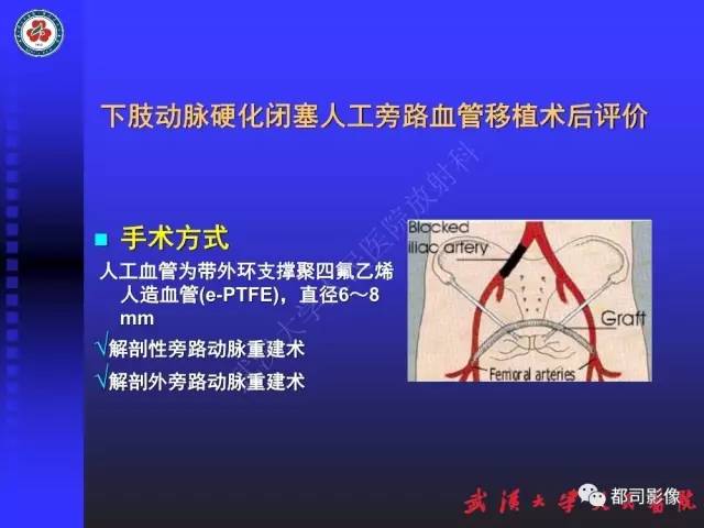 【PPT】CTA在血管病变术后评价中的应用