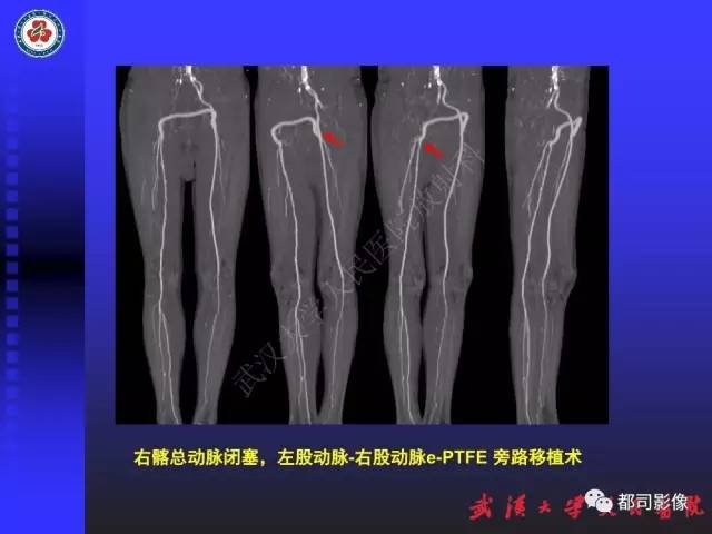 【PPT】CTA在血管病变术后评价中的应用