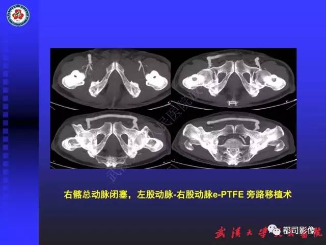 【PPT】CTA在血管病变术后评价中的应用