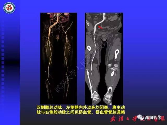 【PPT】CTA在血管病变术后评价中的应用