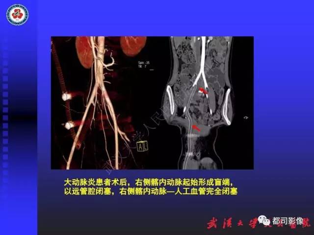【PPT】CTA在血管病变术后评价中的应用