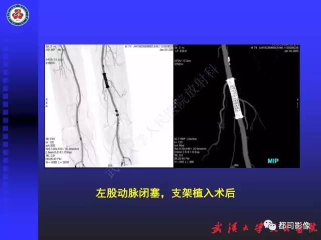 【PPT】CTA在血管病变术后评价中的应用