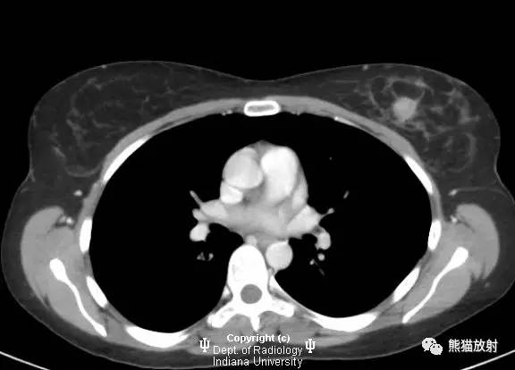 【双语病例】乳腺浸润性导管癌1例X线钼靶
