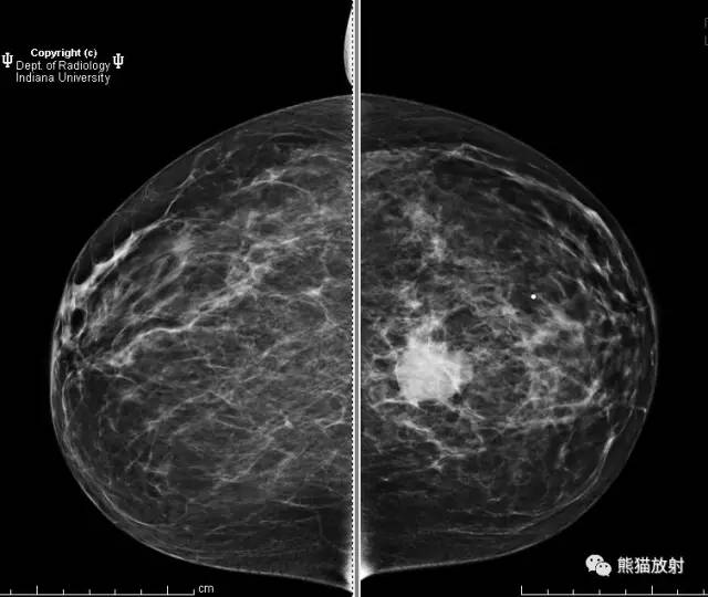 【双语病例】乳腺浸润性导管癌1例X线钼靶 【双语病例】乳腺浸润性导管癌1例X线钼靶