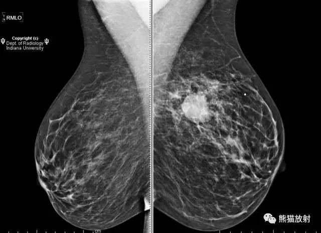 【双语病例】乳腺浸润性导管癌1例X线钼靶 【双语病例】乳腺浸润性导管癌1例X线钼靶