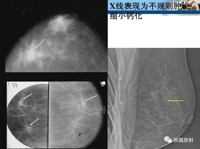 【双语病例】乳腺浸润性导管癌1例X线钼靶 【双语病例】乳腺浸润性导管癌1例X线钼靶
