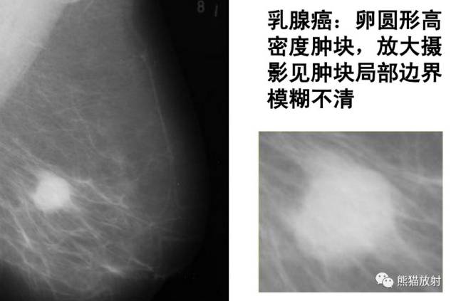 【双语病例】乳腺浸润性导管癌1例X线钼靶 【双语病例】乳腺浸润性导管癌1例X线钼靶