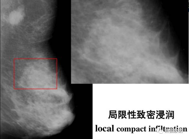 【双语病例】乳腺浸润性导管癌1例X线钼靶 【双语病例】乳腺浸润性导管癌1例X线钼靶