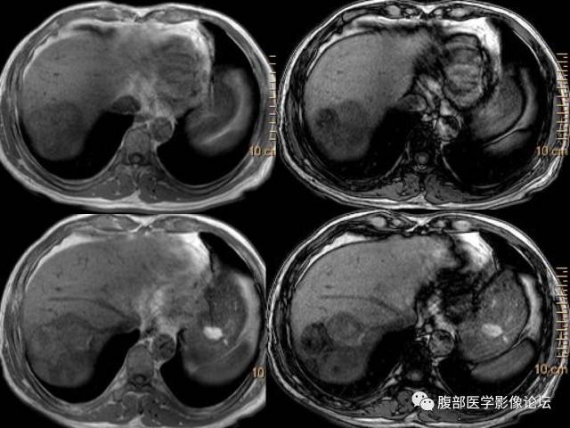 【病例】肝右叶肝透明细胞癌1例CT及MR
