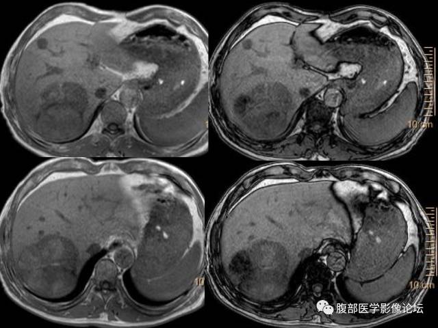 【病例】肝右叶肝透明细胞癌1例CT及MR