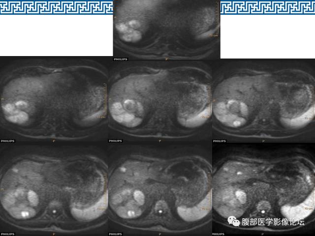 【病例】肝右叶肝透明细胞癌1例CT及MR