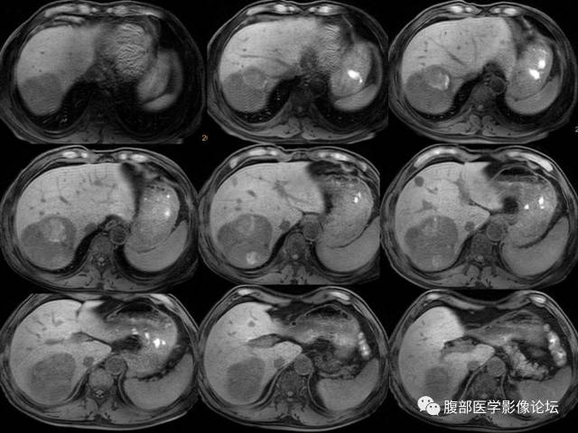 【病例】肝右叶肝透明细胞癌1例CT及MR