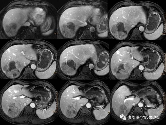 【病例】肝右叶肝透明细胞癌1例CT及MR