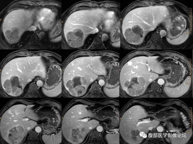 【病例】肝右叶肝透明细胞癌1例CT及MR