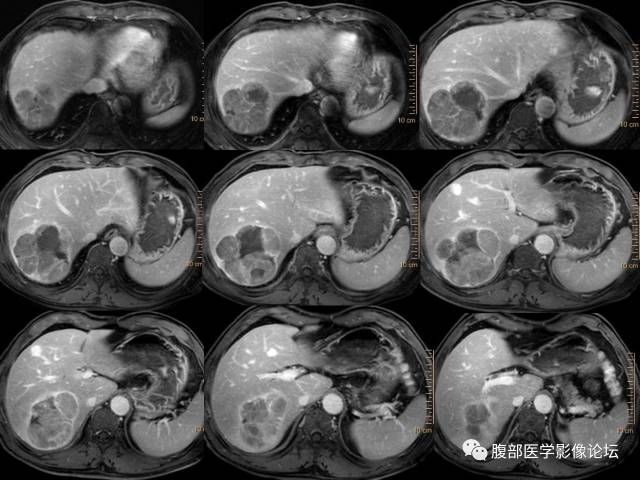 【病例】肝右叶肝透明细胞癌1例CT及MR