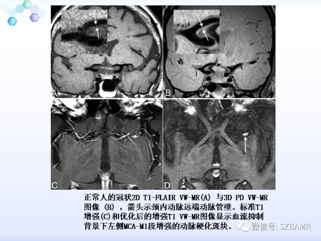 【PPT】2017ASN颅内血管壁MRI：原则及专家共识