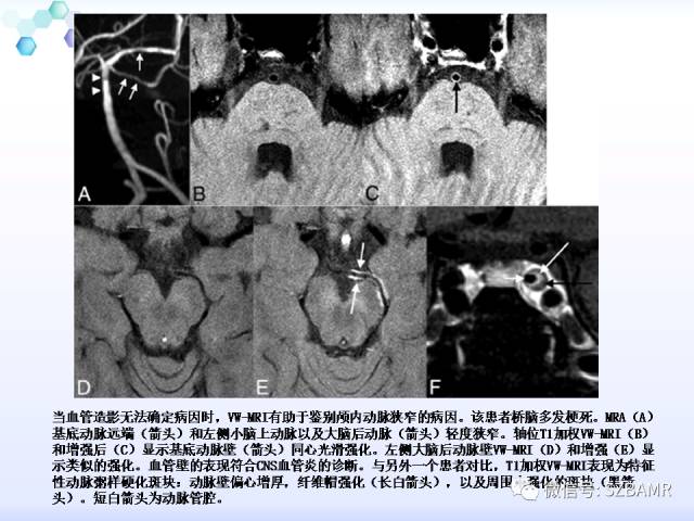 【PPT】2017ASN颅内血管壁MRI：原则及专家共识