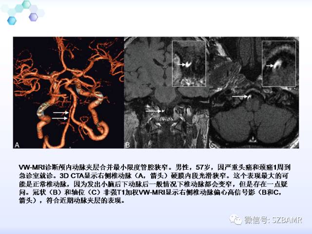 【PPT】2017ASN颅内血管壁MRI：原则及专家共识
