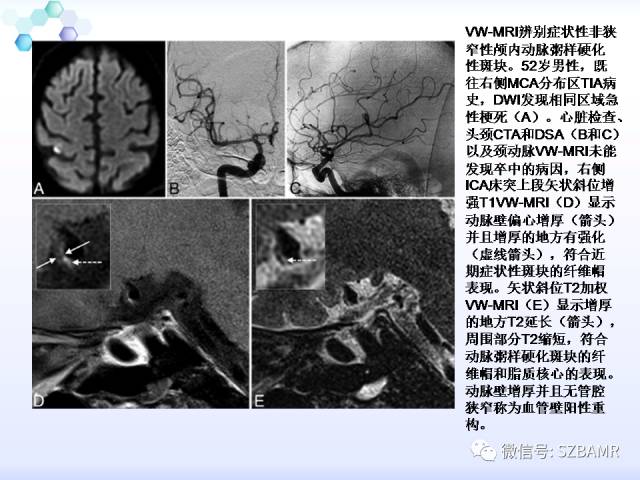 【PPT】2017ASN颅内血管壁MRI：原则及专家共识