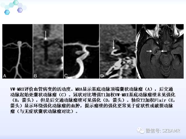 【PPT】2017ASN颅内血管壁MRI：原则及专家共识