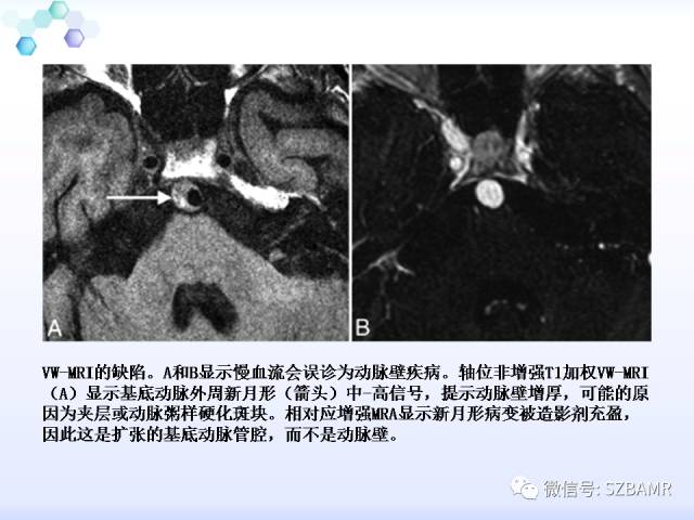 【PPT】2017ASN颅内血管壁MRI：原则及专家共识
