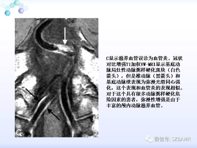 【PPT】2017ASN颅内血管壁MRI：原则及专家共识