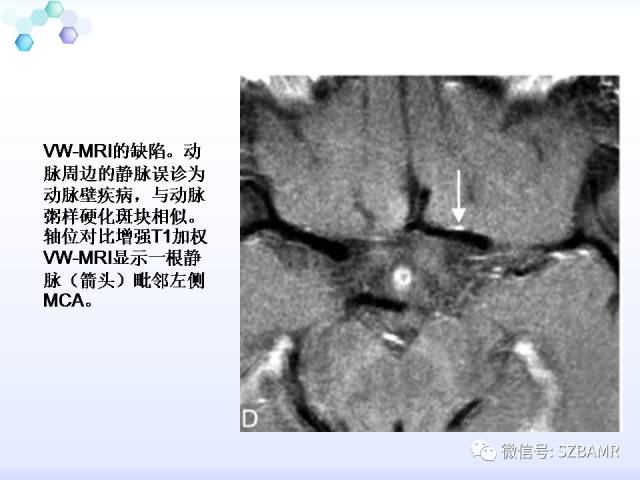 【PPT】2017ASN颅内血管壁MRI：原则及专家共识