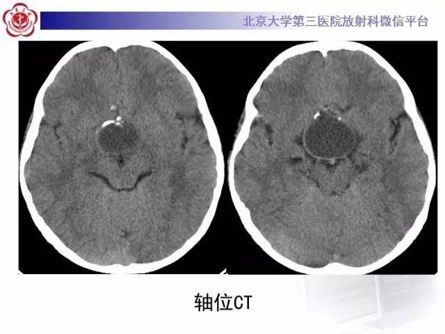 【病例】颅咽管瘤1例CT及MR影像表现