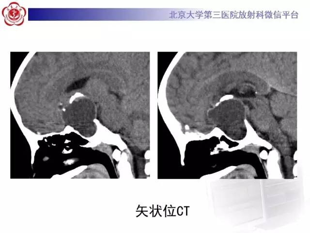 【病例】颅咽管瘤1例CT及MR影像表现